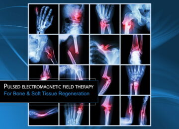 Research News: PEMF Therapy Demonstrates Enhanced Bone Repair Effect in Trials
